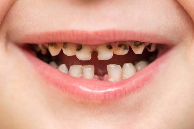 تفسير حلم الأسنان السوداء لابن سيرين - مدونة صدى الامة
