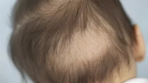 Alopecia treatment from the pharmacy