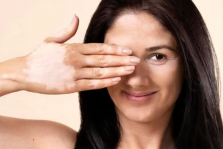 البهاق في اليد