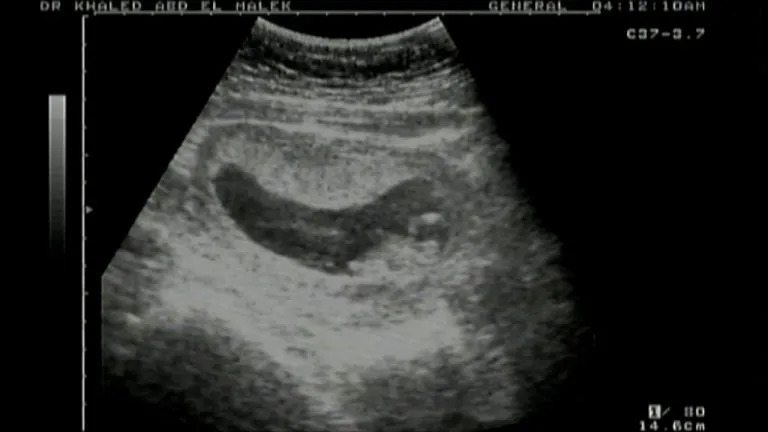 الحمل في الشهر الثاني بالصور