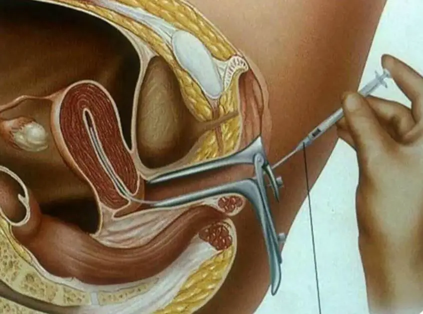 Is the colored picture of the uterus painful?