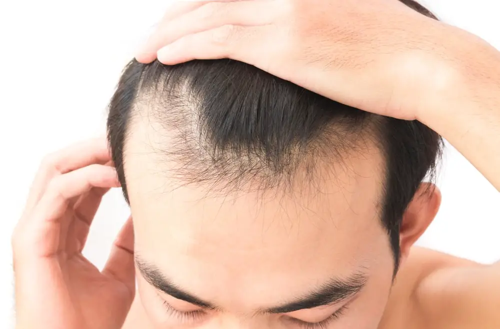 أسباب تساقط الشعر عند الرجال من الأمام