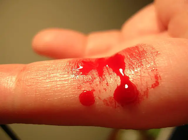 Bleeding finger - مدونة صدى الامة