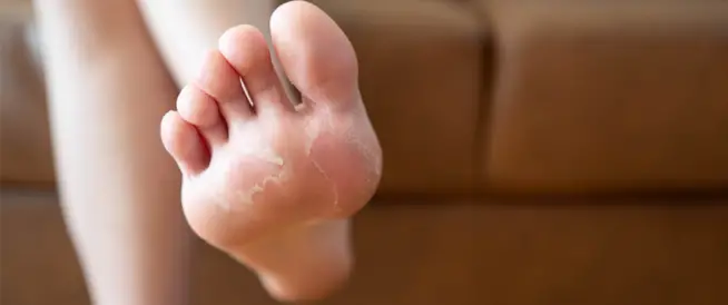 Peeling foot skin