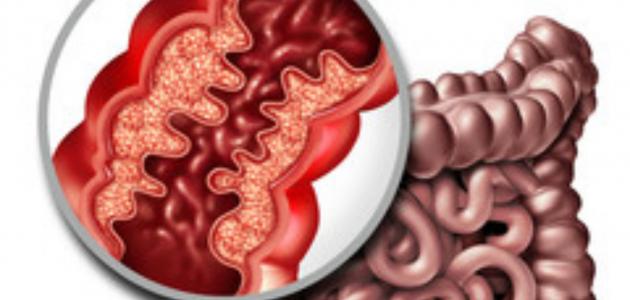 اعراض انسداد الأمعاء