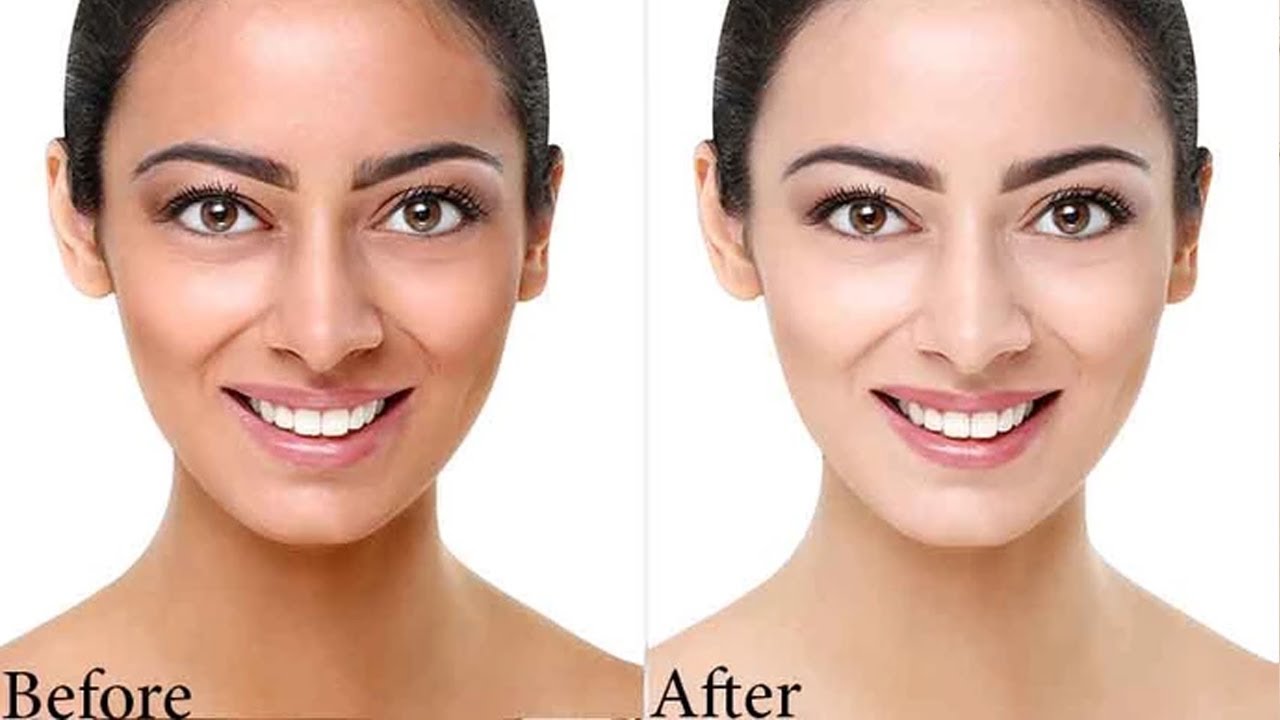 My experience with glutathione injections