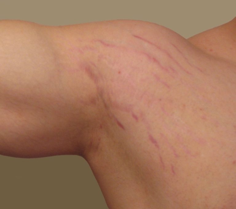 تجربتي مع ليزر الفراكشنال للتشققات