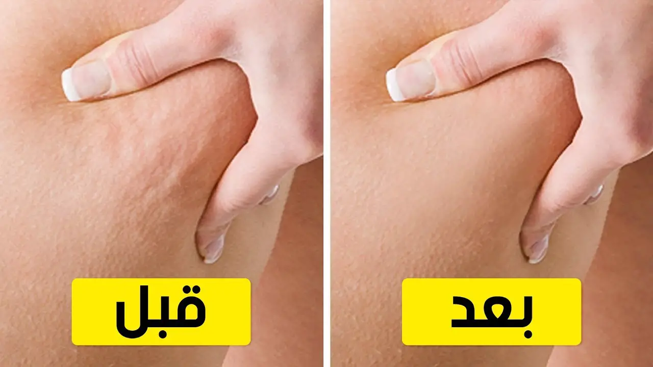 تجربتي مع السيلوليت