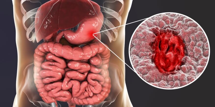 تجربتي مع التهاب المعدة والقولون