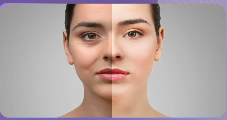 من جربت عملية شد الجفون؟