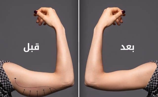 شفط الدهون بالفيزر