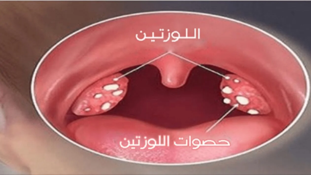 تجربة حصوات اللوز