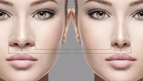 تجربتي عملية تجميل الأنف