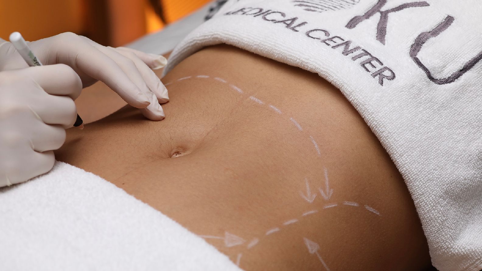 My experience with a tummy tuck