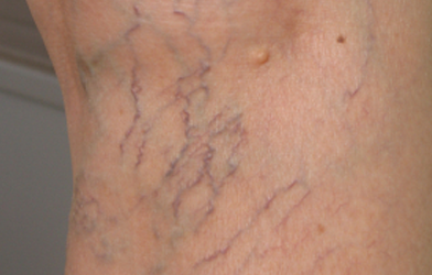 ليزر الشعيرات الدموية