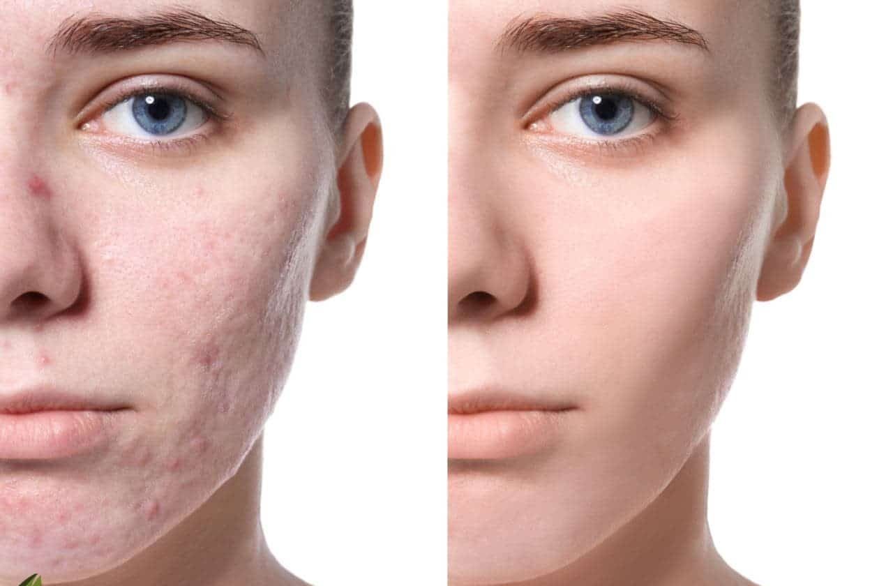 قطع الندبات