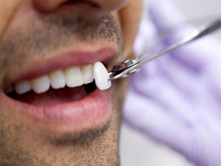 Dental veneers - Sada Al Umma blog
