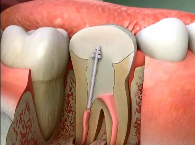 عصب الأسنان - مدونة صدى الامة