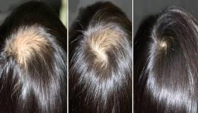 I-Cream yeenwele ze-alopecia .. unyango lwe-alopecia kwi-pharmacy