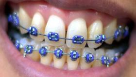 Ortodonti: Få et lyst smil til uimodståelige priser!