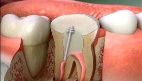 歯科神経充填とその重要性についてあなたの知らないこと!