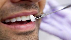歯科用ベニアの取り付け方法と取り付けの利点は何ですか?