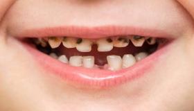 تفسير حلم الأسنان السوداء لابن سيرين